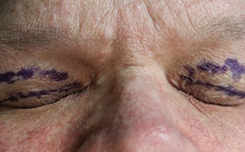Change in blepharoplasty requirement