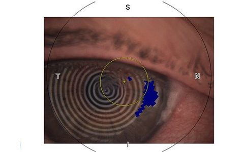 Optometry skills aid recovery from corneal injury during gardening