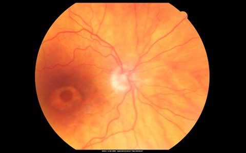 Prevalence of hydroxychloroquine (Plaquenil) retinopathy higher than previously thought