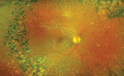 Pharma Open Access: Ultra-wide field imaging and diabetic retinopathy
