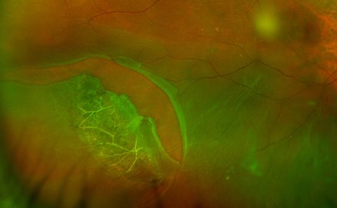 Looming myopia problem: an ophthalmologist’s perspective