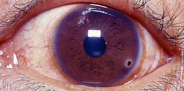Let's talk about MBS item 10944 Optometry Australia