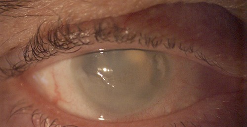 0285A - Case CD -  white eye right eye - online