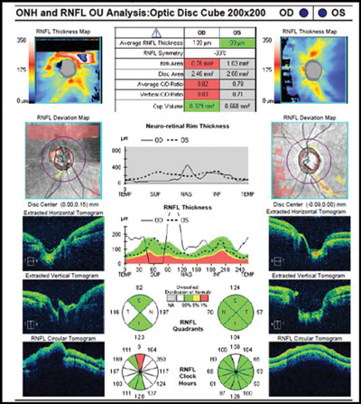 GLAUCOMA-Figure -1