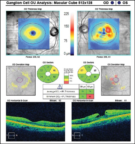 GLAUCOMA-Figure -2