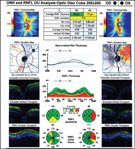 GLAUCOMA-Figure -3