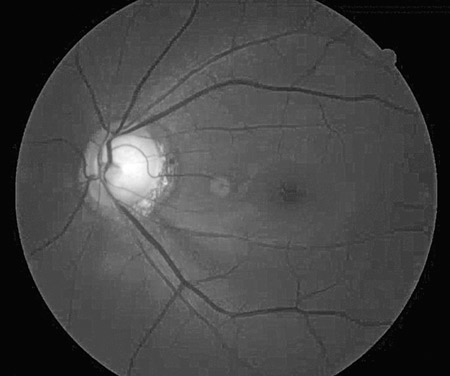 GLAUCOMA-Figure -4