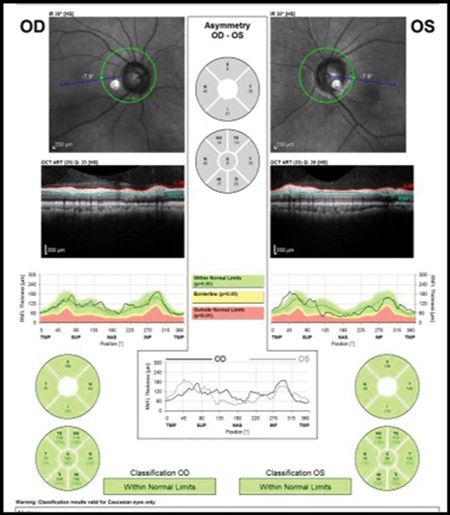 GLAUCOMA-Figure -4b