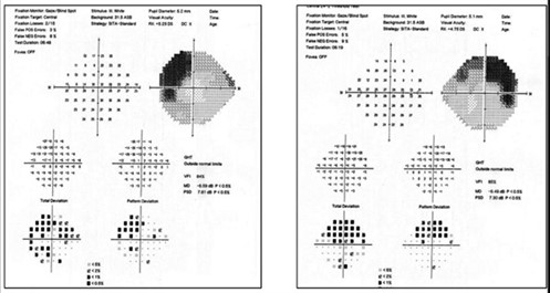 GLAUCOMA-Figure -6