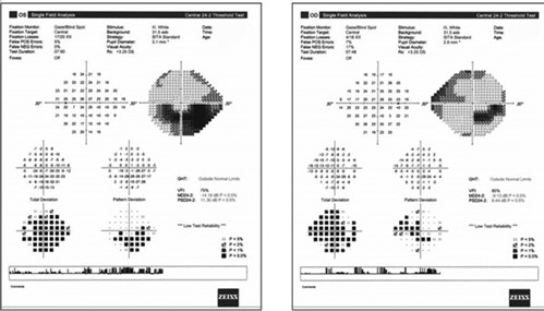 GLAUCOMA-Figure -7