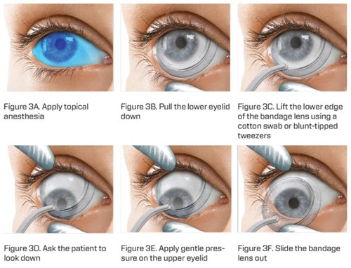 Pharma -ONLINE-June -Lens -bandage -Figures -3A-3F