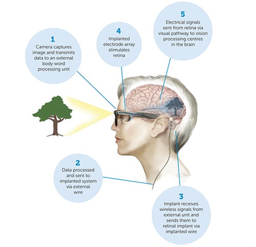 bionic vision device - online