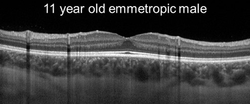 Emmetropic retina - online