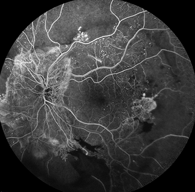 fluroscein angiogram DR  Photo Amira Howari - online