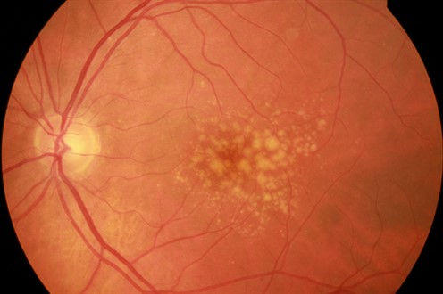 Intermediate Fundus