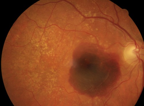 Late AMD Fundus