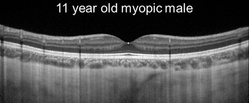 Myopic retina - online