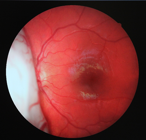 Retinoblastoma before treatment - Online