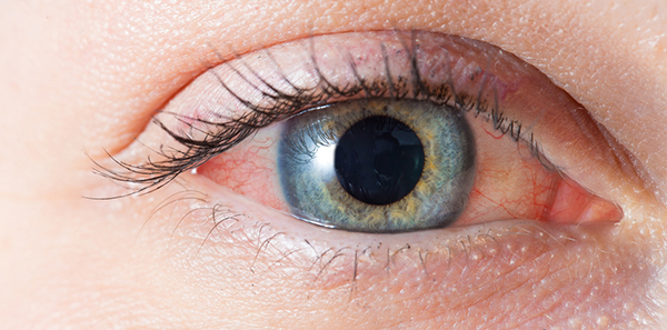 Could chlamydia be the cause? - Optometry Australia