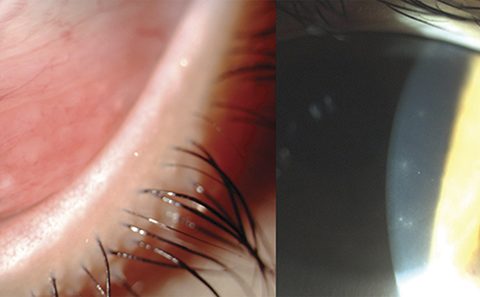 Trial aims to find viral conjunctivitis treatment